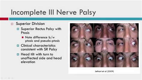 Cranial Nerve Palsy Causes