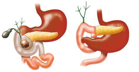 Whipple Procedure | Johns Hopkins Medicine