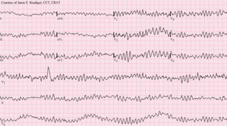 Medicine:Primary ventricular fibrillation - HandWiki