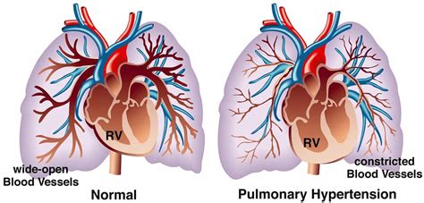 Pulmonary hypertension & pulmonary arterial hypertension causes ...