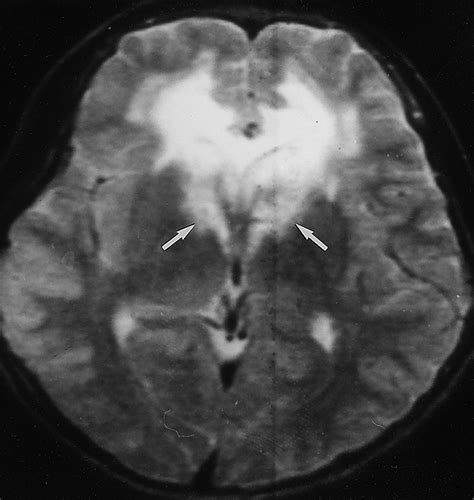 Leukodystrophy in Children: A Pictorial Review of MR Imaging Features ...