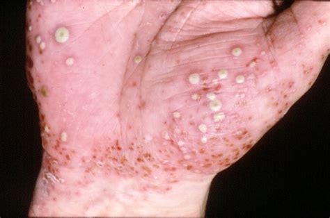 What does pustular psoriasis look like and how is it different?