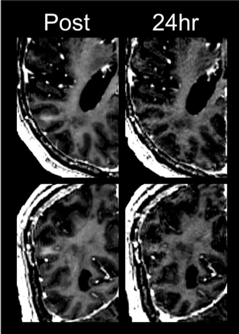 Blood-Brain Barrier Opening with Focused Ultrasound in Parkinson´s ...