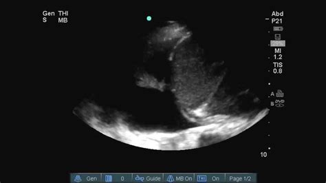 Pleural Effusion On Ultrasound