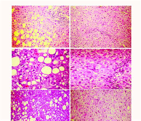 Liver biopsies from people with MetS, at baseline in the left panel ...