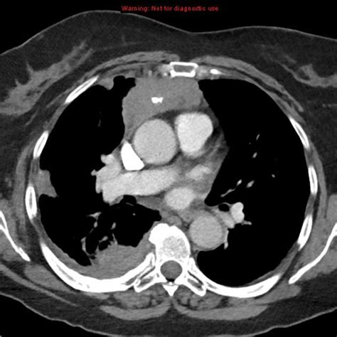 Invasive thymoma - Anterior mediastinal mass with irregular borders and ...