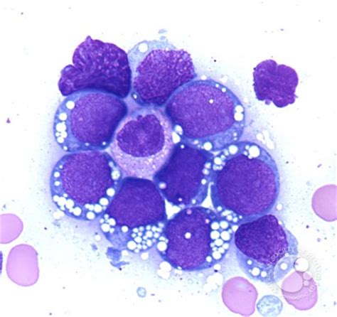 Burkitt lymphoma-leukemic phase