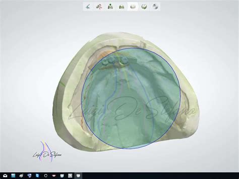 Removable implant-supported prosthesis. Case report - MyZerodonto