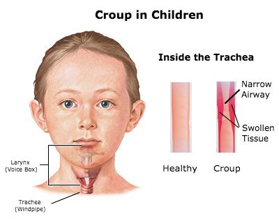 KidzAid Australia | Health Facts on Croup