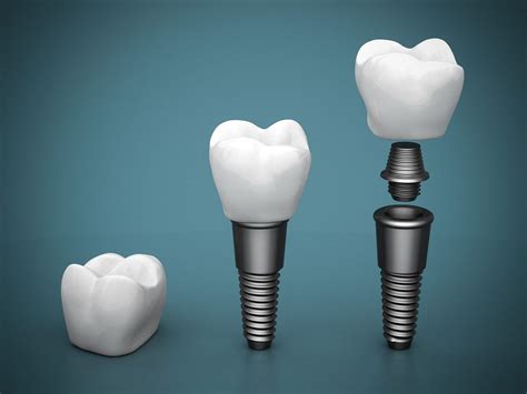 Titanium Dental Implants Sydney CBD I Sydney Dental Aesthetics and Implants