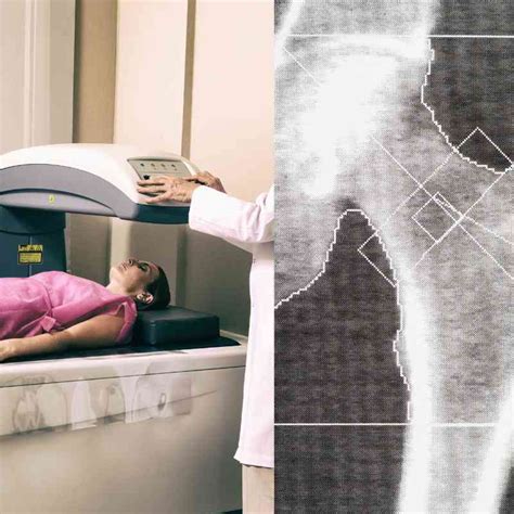 Understanding Your Bone Density Test | What it means for you.