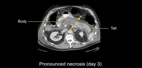 Abdominal CT: necrotizing pancreatitis • LITFL • Radiology Library