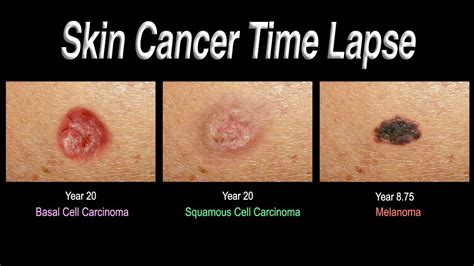 Skin Cancer Time Lapse (Basal Cell Carcinoma, Squamous Cell Carcinoma ...