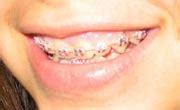 Braces for tooth and teeth alignment.