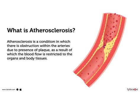 Atherosclerosis: Causes, Symptoms, Treatment and Cost