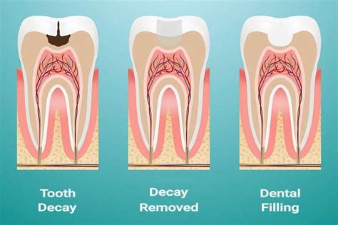 Dental Filling | filling services | free dental appointment | tooth cavity