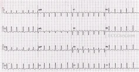 Atrial Fibrillation With A Rapid Ventricular Response | ECG Guru ...