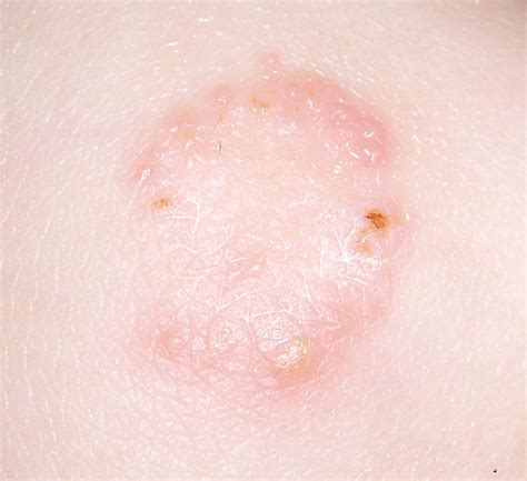 PhysicianMom.com: Is ringworm contagious?