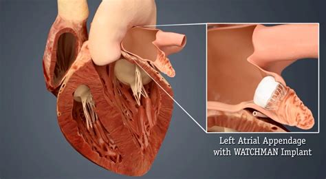 Heart Hospital First in State to Offer Watchman Heart Implant ...