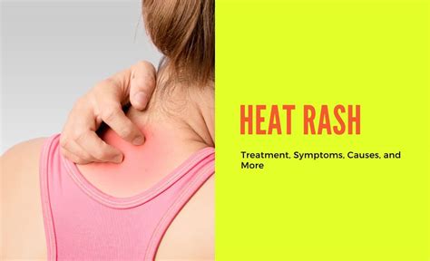 Heat Rash: Treatment, Symptoms, Causes, and More - Resurchify