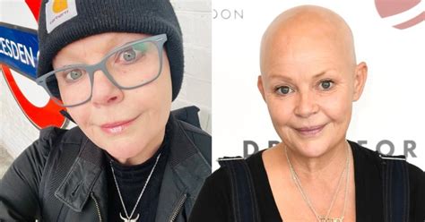 Gail Porter loses eyebrows and eyelashes to alopecia again | Metro News