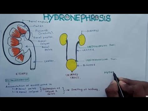 HYDRONEPHROSIS : Pathophysiology, Causes, signs and symptoms ...