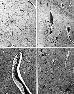 Paraneoplastic Autonomic Neuropathy: Background, Pathophysiology, Etiology