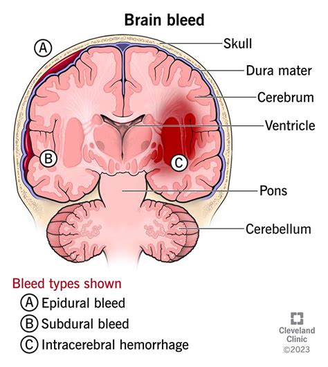 Brain Bleed Intracranial Hemorrhage Causes Symptoms 31212 | The Best ...