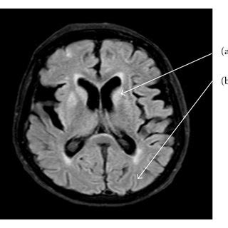 MRI scan demonstrating: (a) high signal in the caudate nucleus and (b ...