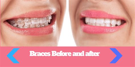 FIND OUT!! Braces Before and After pictures, results, for adults ...