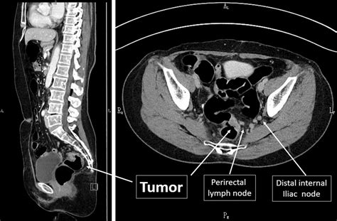 Pelvic Lymph Nodes Anatomy Ct - Human Anatomy