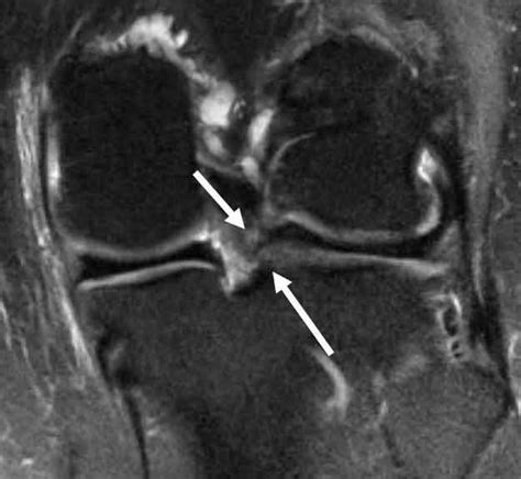 Lateral Meniscus Tear | Complex Knee Surgeon | Minnesota