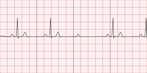 2nd Degree AV Block (Mobitz Type II) - Differential Diagnosis of