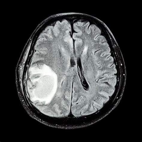 MRI brain : show brain tumor at right parietal lobe of cerebrum Stock ...