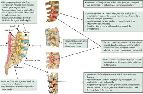 Low back pain - The Lancet