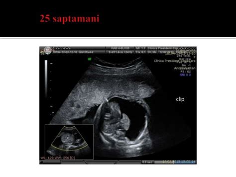 Hidrotorax fetal shunt pleuro amniotic