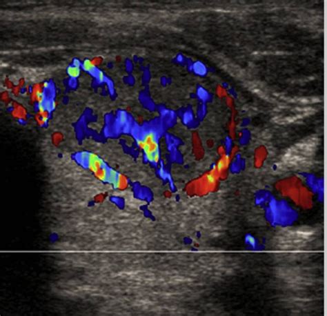 Thyroid Nodules - Causes, Symptoms, Ultrasound, Surgery