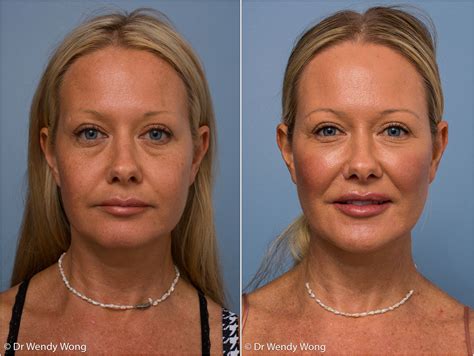 Cosmetic Before and After Gallery | Dr Wendy Wong