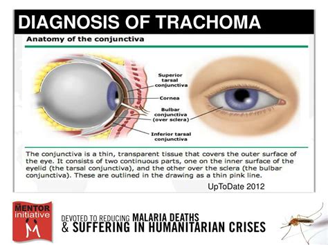 PPT - Trachoma: Diagnosis, Treatment, & Prevention Melina Lopez ...