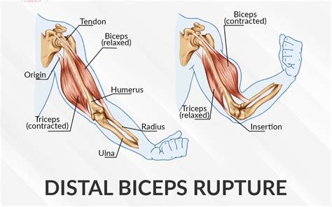 Distal Biceps Rupture - Dr. Saurabh Aggarwal