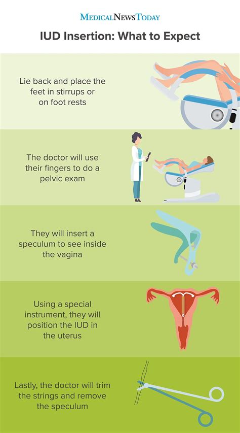 Mirena iud hormones - elementslopte