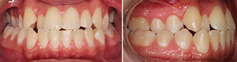 Posterior Crossbite