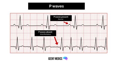 Ekg Interpretation P Wave