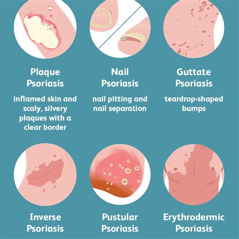 Psoriasis Causes, Symptoms, Treatment, Prevention - Booboone.com