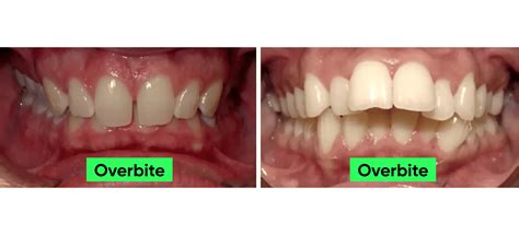 How Can Mewing Fix Overbite | Mewing.coach