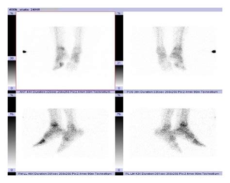 Three-phase bone scan was performed, with attention to the ankles and ...