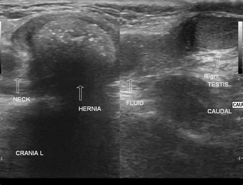 Indirect Inguinal Hernia Ultrasound