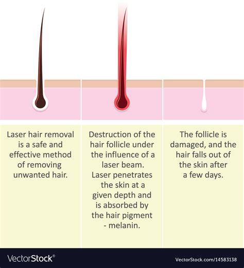 Laser hair removal description procedure Vector Image