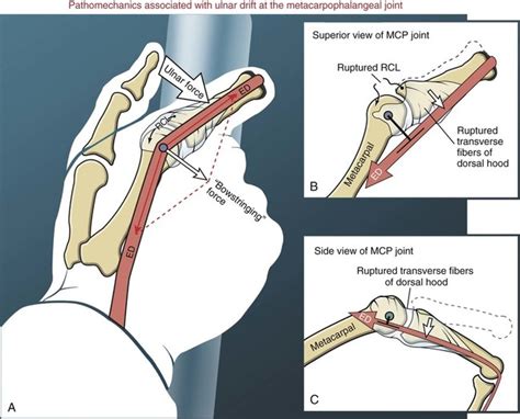 34+ Intrinsic And Extrinsic Muscles Of Hand Background – Anatomy