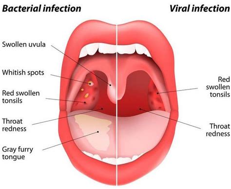 Natural Remedies to Manage Uvulitis | Strep throat remedies, Home ...